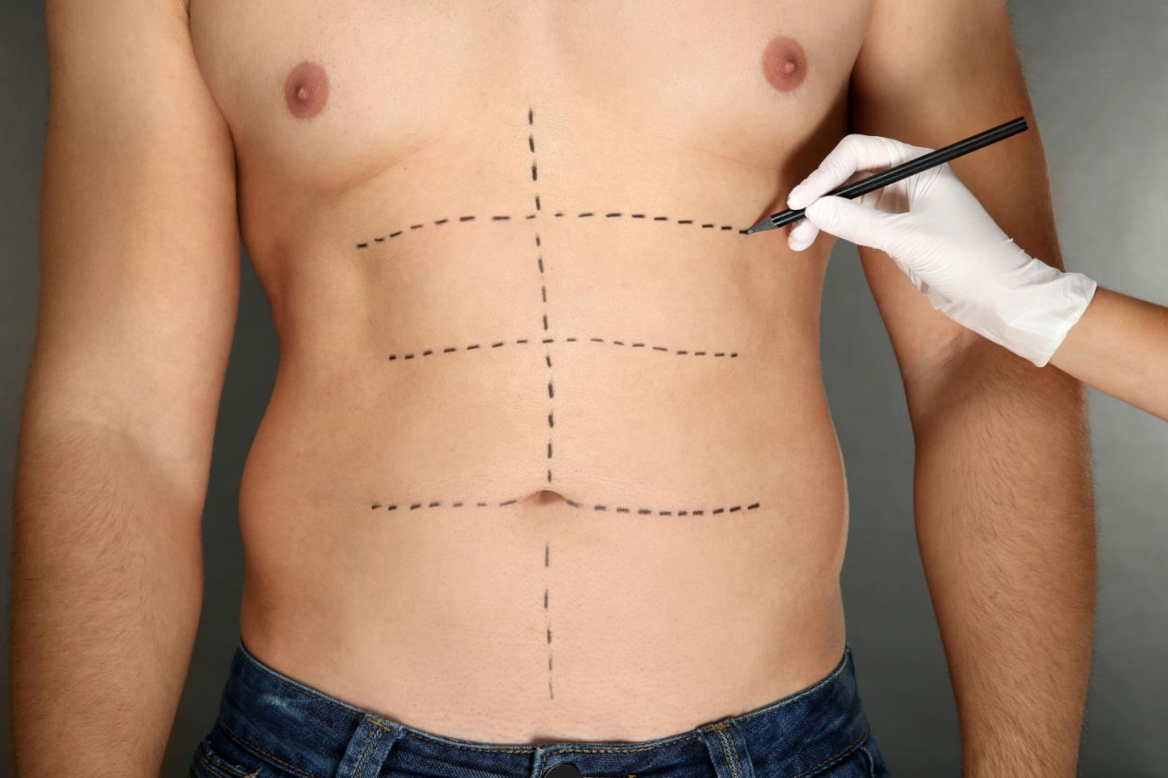 Marcaje quirúrgico en el abdomen antes de una liposucción para definir las áreas de grasa a tratar