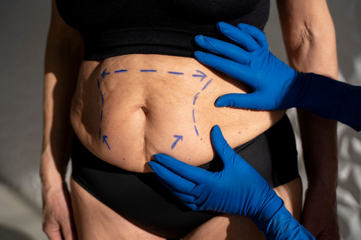 Persona con ropa interior negra, abdomen descubierto y guantes azules dibujando marcas sobre la piel con un rotulador.