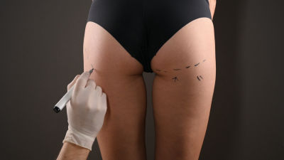 Marcaje en la zona interna de los muslos antes de una liposucción para definir el contorno corporal