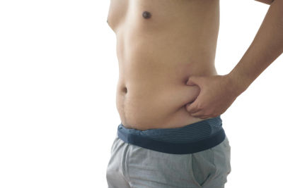 Hombre sujetando grasa abdominal antes de liposucción en el abdomen.