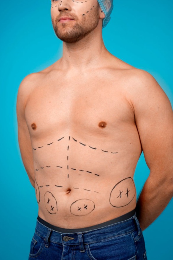 Torso masculino desnudo con varias líneas punteadas dibujadas en el abdomen sobre fondo azul