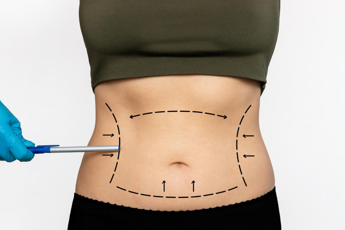 Abdomen femenino con ropa oscura y marcas punteadas dibujadas en la piel, señalado por una mano con guante azul